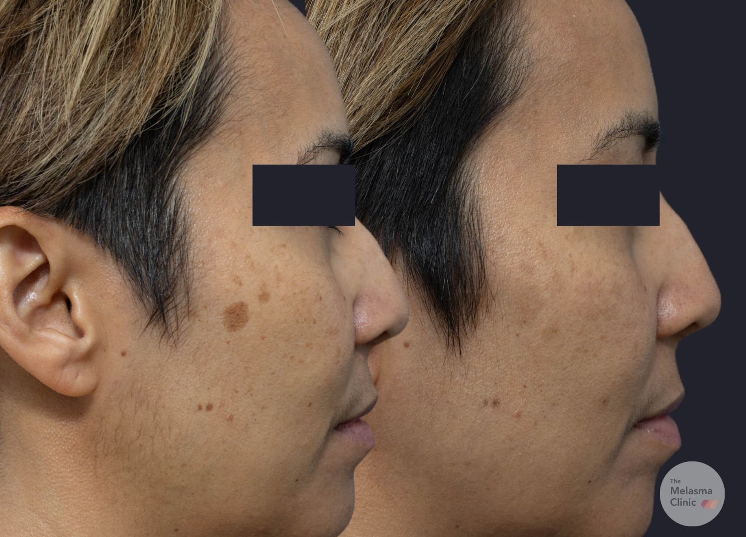 melasma clinic