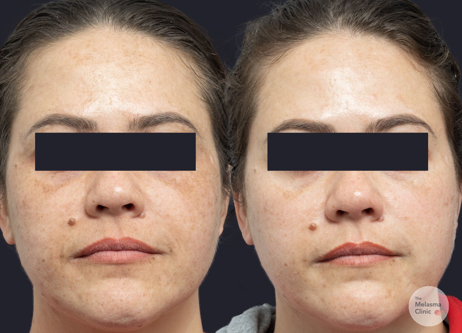 melasma clinic