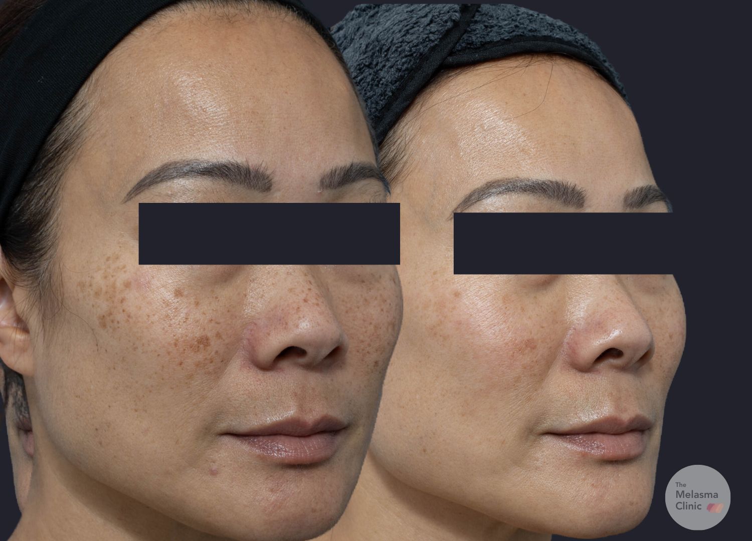 melasma clinic