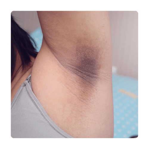 Dark armpits treatment melasma